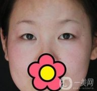 甘肅省人民醫(yī)院割雙眼皮怎么樣？附整形價(jià)格表及真人案例