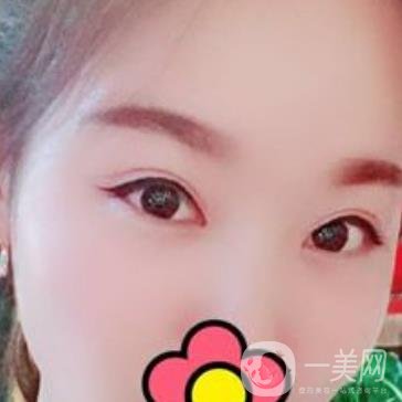 甘肅省人民醫(yī)院割雙眼皮怎么樣？附整形價(jià)格表及真人案例