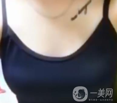 廣東省第二人民醫(yī)院隆胸手術(shù)多少錢？羅盛康案例？附整形價(jià)格表