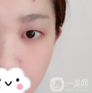 湖南省人民醫(yī)院割雙眼皮要多少錢？整形價格表一覽