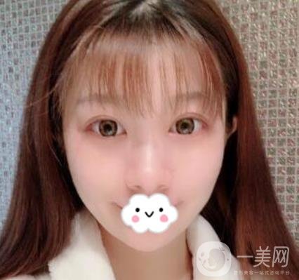 湖南省人民醫(yī)院割雙眼皮要多少錢？整形價格表一覽