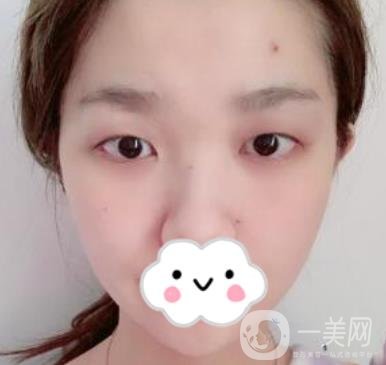 湖南省人民醫(yī)院割雙眼皮要多少錢？整形價格表一覽