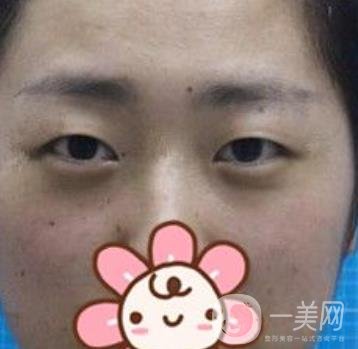秦皇島人民醫(yī)院雙眼皮怎么樣？附整形價(jià)格表及案例圖