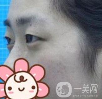 秦皇島人民醫(yī)院雙眼皮怎么樣？附整形價(jià)格表及案例圖