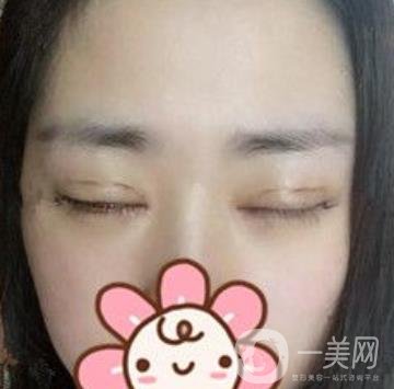 秦皇島人民醫(yī)院雙眼皮怎么樣？附整形價(jià)格表及案例圖