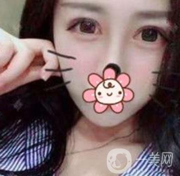 秦皇島人民醫(yī)院雙眼皮怎么樣？附整形價(jià)格表及案例圖