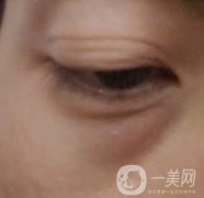 寶雞市人民醫(yī)院美容科價格表，去眼袋手術(shù)案例展示