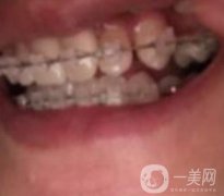 蘭山區(qū)人民醫(yī)院整牙多少錢？牙齒矯正案例分享