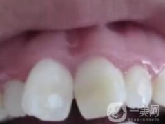 泉州人民醫(yī)院整牙多少錢？牙齒矯正恢復(fù)情況介紹