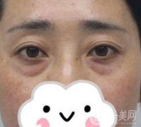 第九人民醫(yī)院美容科價(jià)格表，去眼袋手術(shù)恢復(fù)情況一覽