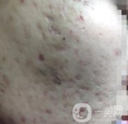 綿陽中心醫(yī)院整形美容科祛痘坑怎么樣？價(jià)格表及術(shù)后果分享
