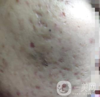 綿陽中心醫(yī)院整形美容科祛痘坑怎么樣？價格表及術(shù)后*果分享