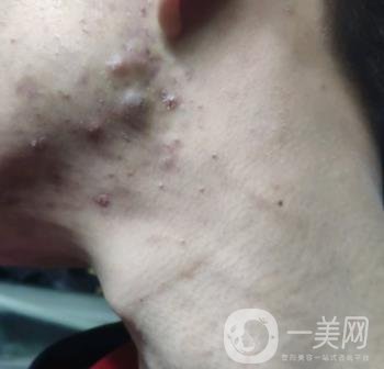綿陽中心醫(yī)院整形美容科祛痘坑怎么樣？價格表及術(shù)后*果分享
