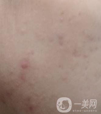 綿陽中心醫(yī)院整形美容科祛痘坑怎么樣？價格表及術(shù)后*果分享