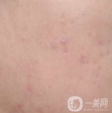 綿陽中心醫(yī)院整形美容科祛痘坑怎么樣？價格表及術(shù)后*果分享