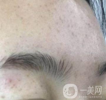 南京省中醫(yī)院整形美容科祛黃褐斑多少錢？價格表及案例詳情一覽