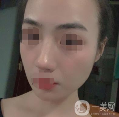 南京省中醫(yī)院整形美容科祛黃褐斑多少錢？價格表及案例詳情一覽