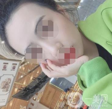 南京省中醫(yī)院整形美容科祛黃褐斑多少錢？價格表及案例詳情一覽