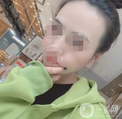 南京省中醫(yī)院整形美容科祛黃褐斑多少錢？價格表及案例詳情一覽