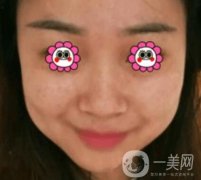 岳陽市第一人民醫(yī)院整形美容科祛斑好嗎？價(jià)格表和案例日記分享