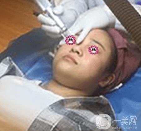 岳陽市第一人民醫(yī)院整形美容科祛斑好嗎？價(jià)格表和案例日記分享