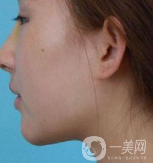河北省中醫(yī)院整形美容科隆鼻怎么樣？?jī)r(jià)格表及術(shù)后恢復(fù)日記分享