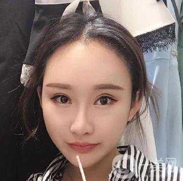 河北省中醫(yī)院整形美容科隆鼻怎么樣？?jī)r(jià)格表及術(shù)后恢復(fù)日記分享
