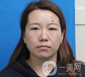 贛州市人民醫(yī)院整形科價(jià)格表，附祛眼袋案例分享