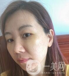 贛州市人民醫(yī)院整形科價(jià)格表，附祛眼袋案例分享