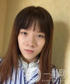 南昌二附院整形科價(jià)格表2020，附肋軟骨隆鼻整形案例