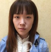 南昌二附院整形科價(jià)格表2020，附肋軟骨隆鼻整形案例