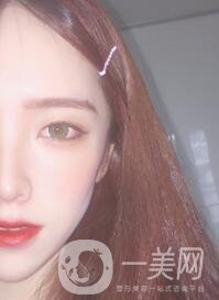 南昌二附院整形科價(jià)格表2020，附肋軟骨隆鼻整形案例