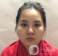 景德鎮(zhèn)第一人民醫(yī)院整形科價(jià)格表，附面部吸脂瘦臉案例