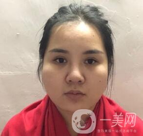 景德鎮(zhèn)第一人民醫(yī)院整形科價(jià)格表，附面部吸脂瘦臉案例