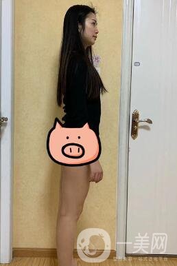 福建省立醫(yī)院整形科價(jià)格(目)表2020，附大小腿吸脂案例