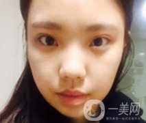 西安唐都醫(yī)院價格表價目表，內(nèi)附吳瓊隆鼻整形日記