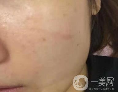 西安市中心醫(yī)院整形科價(jià)目?jī)r(jià)格一覽，附陶諫祛疤案例*果圖