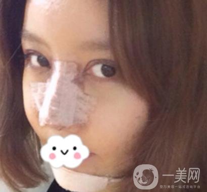 泉州二院整形外科可以打玻尿酸嗎？附價(jià)格表及玻尿酸隆鼻案例