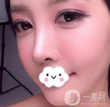 泉州二院整形外科可以打玻尿酸嗎？附價(jià)格表及玻尿酸隆鼻案例
