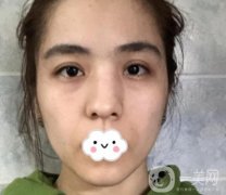 上海伯思立整形怎么樣？附沈國(guó)雄隆鼻案例及整形價(jià)格表