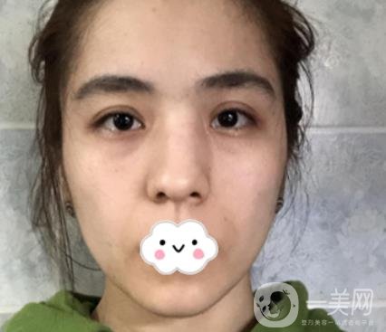 上海伯思立整形怎么樣？附沈國(guó)雄隆鼻案例及整形價(jià)格表