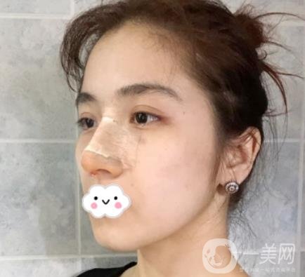 上海伯思立整形怎么樣？附沈國(guó)雄隆鼻案例及整形價(jià)格表