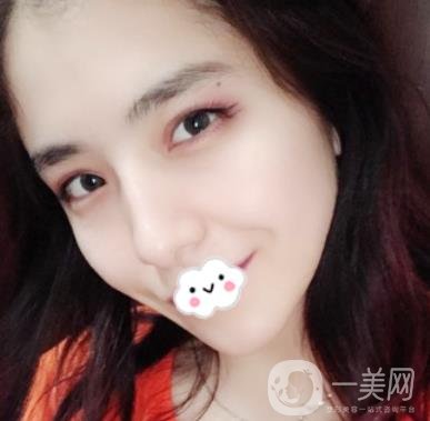 上海伯思立整形怎么樣？附沈國(guó)雄隆鼻案例及整形價(jià)格表