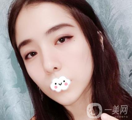 上海伯思立整形怎么樣？附沈國(guó)雄隆鼻案例及整形價(jià)格表