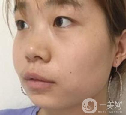 上海華美李志海磨骨多少錢？案例有嗎？整形價(jià)格表一覽
