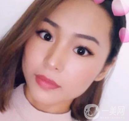 上海九院切下頜角手術(shù)經(jīng)歷分享，附2020整形價(jià)格一覽表