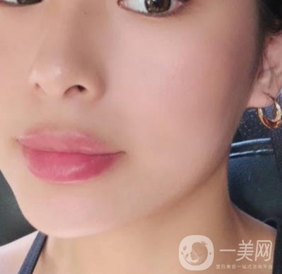 上海九院切下頜角手術(shù)經(jīng)歷分享，附2020整形價(jià)格一覽表
