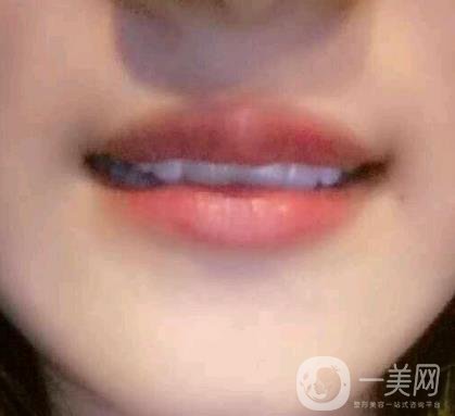 北京市海淀醫(yī)院整牙多少錢？看價格表及案例*果