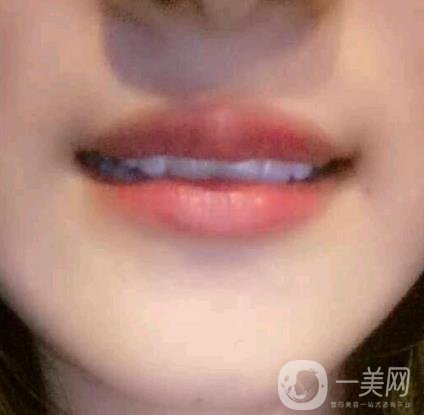 北京市海淀醫(yī)院整牙多少錢？看價格表及案例*果