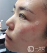 吉大一院整形美容科價格表費用明細(xì)，附祛斑案例